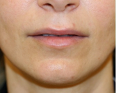 Feel Beautiful - Upper Lip Lift & Lower Lip W-Plasty 211 - Before Photo